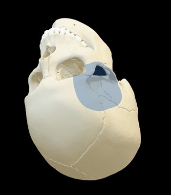 slide_0002_Frontoorbitozigomatica