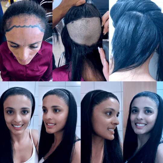 transplante_0002_001