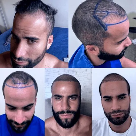 transplante_0000_003