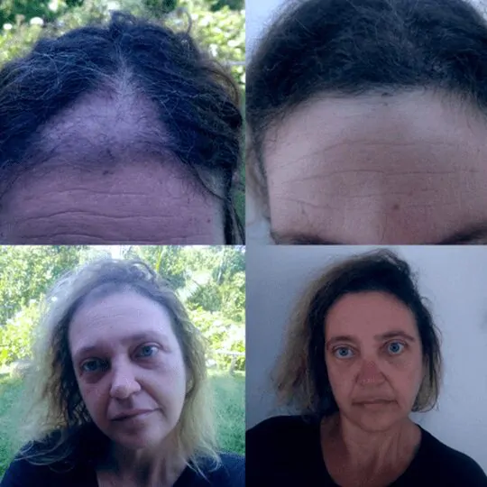 transplante_0001_002